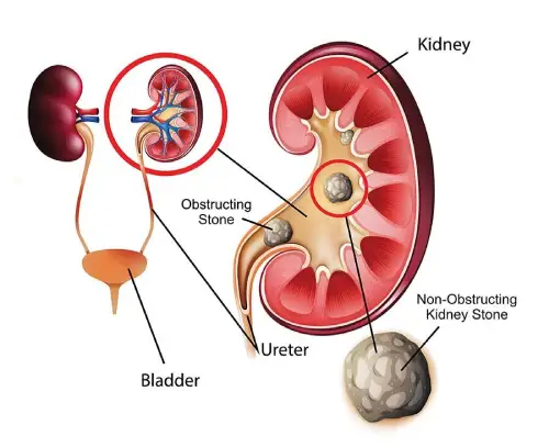 Urinary Tract Obstruction